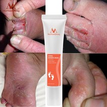 무좀 치료 기기 지료제 무좀 치료 기기 지료제 발 냄새 제거 발 크림 발 관리 건조 방지 발 뒤꿈치 수리