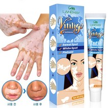 BT 백반증 치료 연고 손 목 몸 얼굴 연피부 백반증치료, 20g, 1개