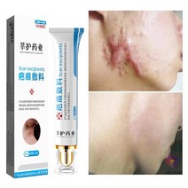 영양크림 매끈한 하얀 피부여드름 흉터 제거 여드름 스트레치 마크 페이스 젤 제거 여드름, 없음