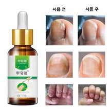 손톱 곰팡이 치료 에센스 제거 젤 항감염 손발톱진균증 무좀치료제 풋 케어 세럼, 1개, 30ml