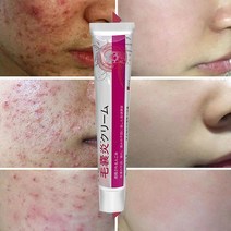 피부가려움증 모낭염 연고 지루성피부염 건선연고 여드름 습진 크림, 2개, 20g