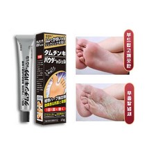AIDEKAI 무좀약 무좀 연고 발톱무좀치료방법 발톱무좀약 발톱무좀 치료 (습진 가려움 악성체취 발냄새 발각질 완화), 15g