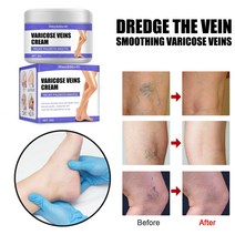 바디파운데이션 Effective Varicose Veins Relief Cream Relieve Vasculitis Phlebitis Spider Pain Treatment Oin