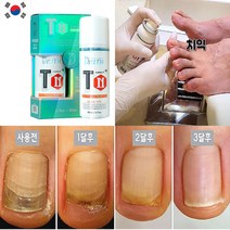 무좀 발톱 문제성 유해균 발 개선 약스프레이 연고 크림 내성발톱 각질 관리