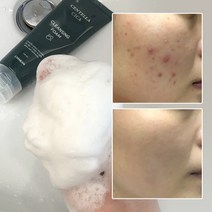 착한팩토리 1+1 여드름 기능성 클렌징폼 좁쌀 아크네 사춘기 청소년 화장품 수부지 센텔라 시카 클렌저, 1+1 여드름 모공 피지 각질 제거 센텔라시카 폼클렌징