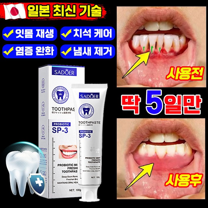 [효과 보장]잇몸 재생 치약 잇몸치약 약국 전용 잇치 치약 치주염 잇몸붓기 이빨 염증 케어 개선 예방 통증 완화 냄새 얼룩 제거 포장 증정