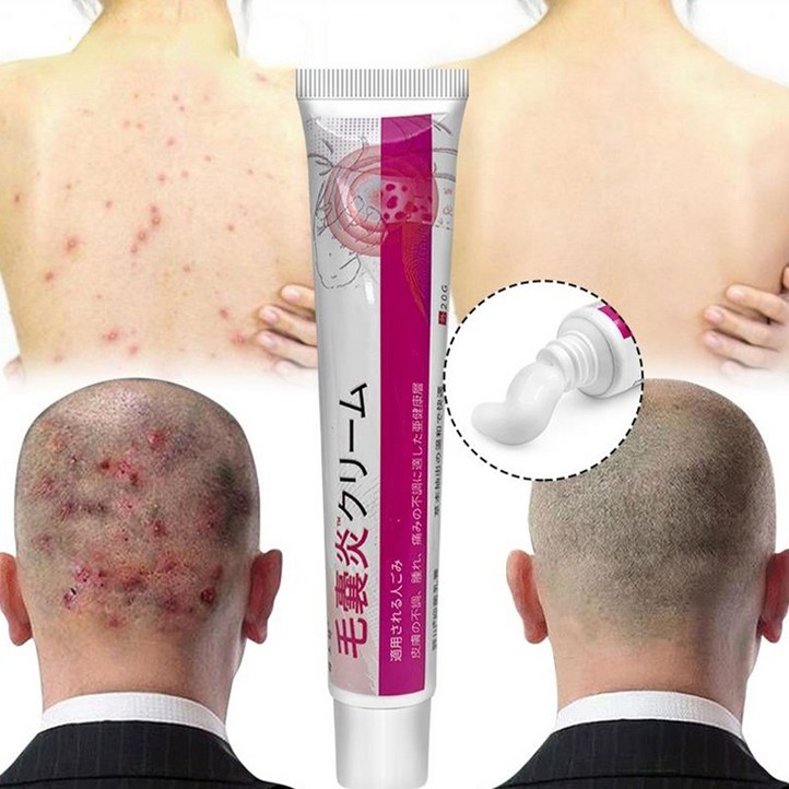 피부가려움증 연고 지루성피부염 모낭염 연고 여드름 크림 피부가려움증 연고 지루성피부염 모낭염 연고 여드름 크림