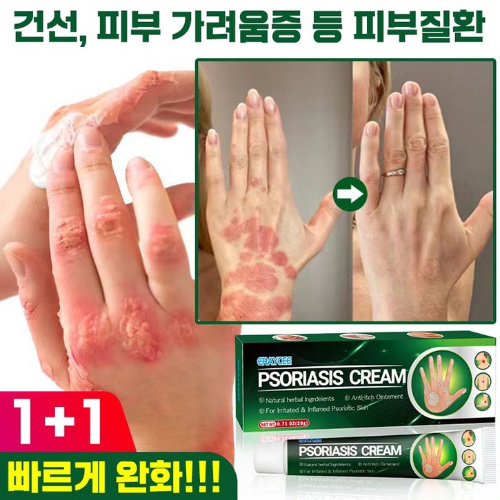 빠른배송 111 건선 피부 가려움증 두드러기 연고 습진 피부관리 크림 피부 외용